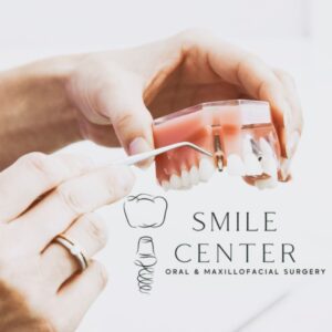 dental implant model